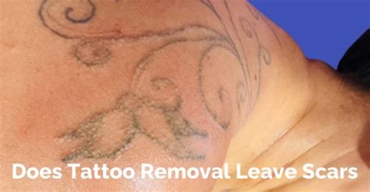 Does cyst Removal leave scars?