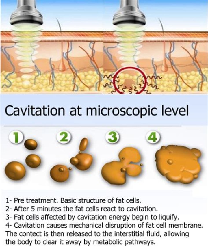 Does ultrasonic cavitation really work?