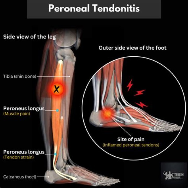 What does tendonitis feel like in the knee?