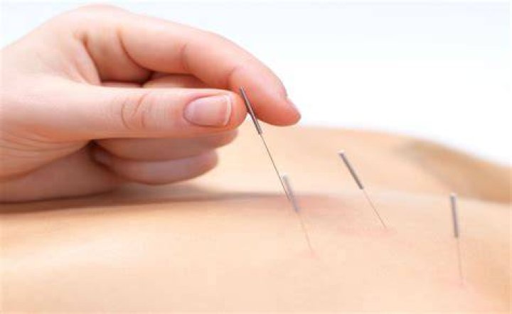 What is needleless acupuncture called?